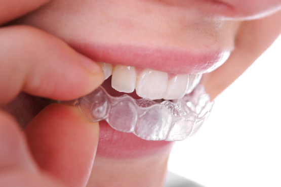 Шинирование зубов. Ременное шинирование: показания, этапы процедуры, последствия2