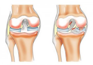 Киста Бейкера коленного сустава: лечение, отзывы, причины, фото3