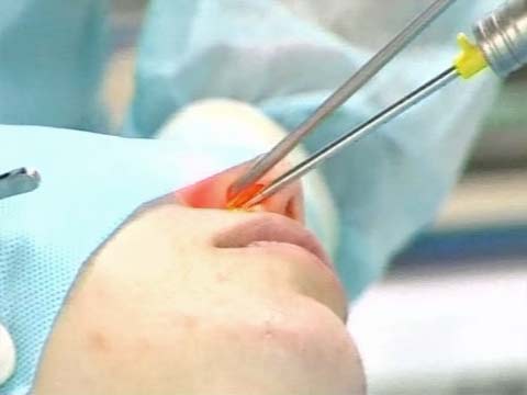 Лечение полипов в носу народными средствами, без операции3