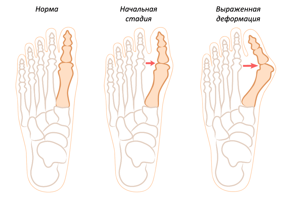 Лечение косточки на пальце ноги: боли, народные средства3