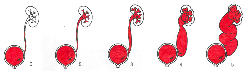 Дивертикулез мочевого пузыря: симптомы, диагностика, лечение3