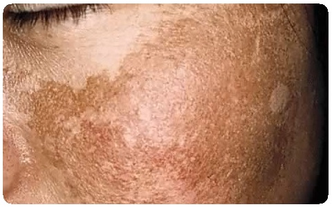 Нарушения пигментации кожи: причины, лечение, фото3