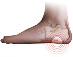 Почему болят пятки ног: причины, симптомы, диагностика, лечение3