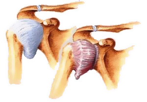 Почему болят мышцы плеча: диагностика, лечение, фото3