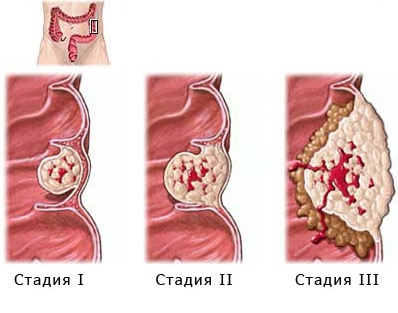 Рак прямой кишки: симптомы, лечение, стадии, фото3