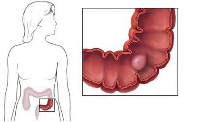 Полипы в кишечнике: симптомы, лечение, удаление, фото3