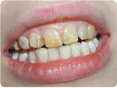 Внутреннее отбеливание депульпированных зубов. Витальное отбеливание зубов3