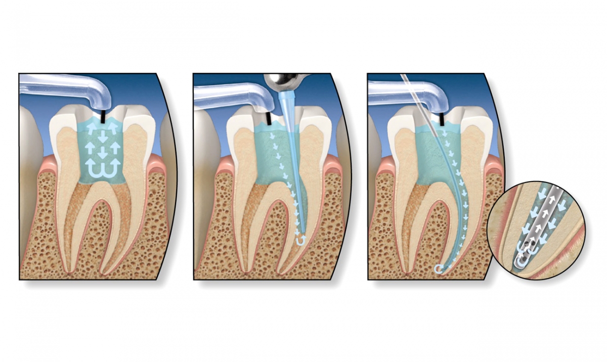 Лечение временных зубов. Некроз пульпы 3