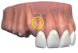 Реплантация зуба. Методики эндодонтического лечения зубов после травмы3