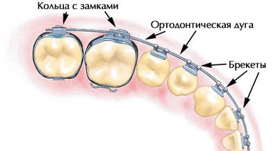 Шинирование зубов. Ременное шинирование: показания, этапы процедуры, последствия3