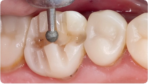 Препарирование зуба: показания, этапы, методы, последствия3