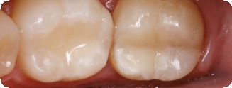 Методика препарирования зубов: показания, этапы3
