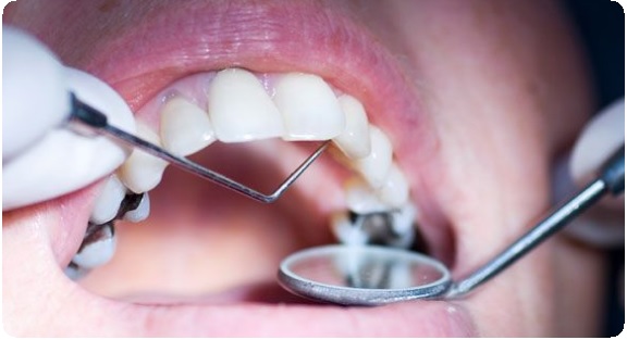 Ретенция зуба и другие дополнительные меры при реставрации3