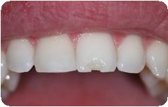 Адгезия в стоматологии: взаимодействие, достоинства, недостатки3