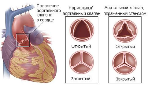 Стеноз аортального клапана: лечение, операция3
