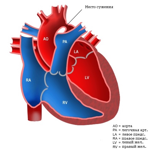 Синдром гипоплазии левых отделов сердца: диагностика, лечение3