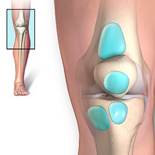 Бурсит коленного сустава: симптомы, лечение в домашних условиях, фото3