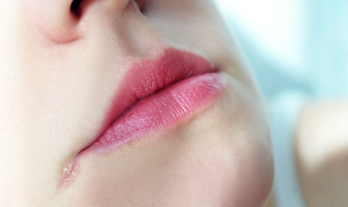 Трещины в уголках губ: причины, лечение, у ребенка, витамины3