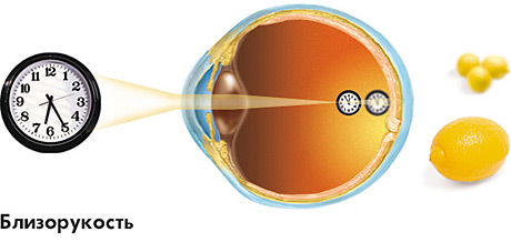 Ухудшение зрения: симптомы, причины, лечение, что делать. Категория болезни глаз. 3