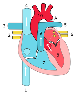 Коарктация аорты: симптомы, диагностика, лечение3