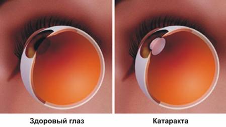 Катаракта глаз: симптомы, лечение, причины, операции, профилактика4