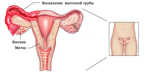 Хламидии у женщин, мужчин: симптомы, лечение, фото4