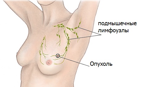 Увеличение груди: минусы и рак груди4
