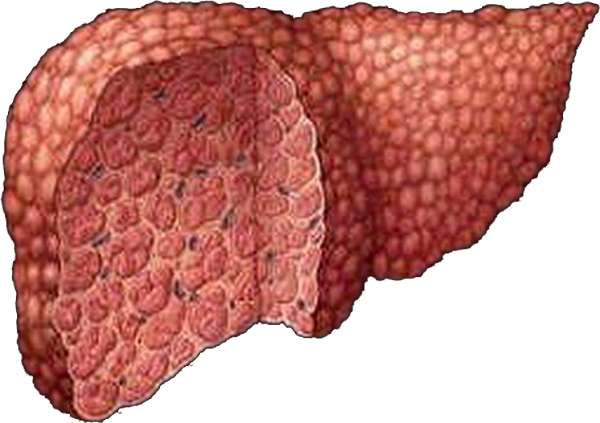 Токсический гепатит:  острая и хроническая формы4
