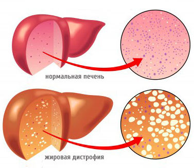 Жировой гепатоз печени: симптомы, лечение4