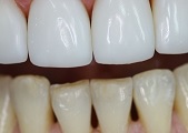 Реставрация депульпированных зубов