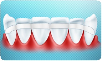 Перелом корня зуба: лечение, методики терапии4