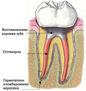 Остеотомия и резекция верхушки корня. Ультразвуковая резекция4