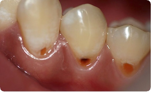 Методика препарирования зубов: показания, этапы4
