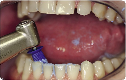 Адгезия в стоматологии: взаимодействие, достоинства, недостатки4