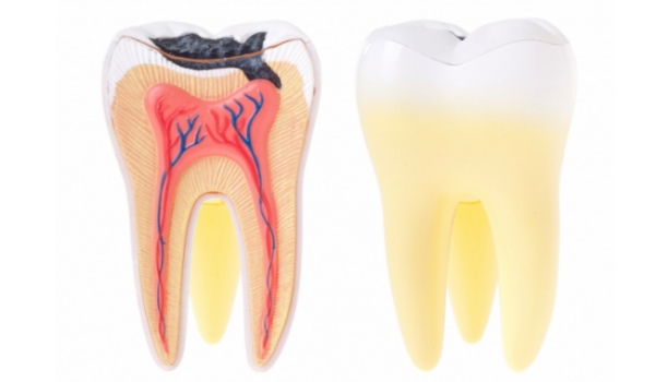 Почему болит зуб после пломбирования каналов: способы лечения и устранения боли4