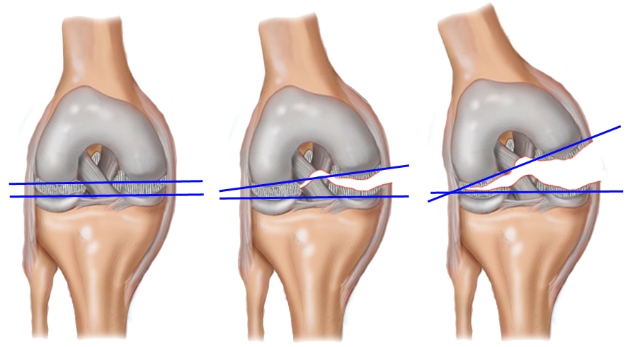 Почему болит колено при сгибании: причины, заболевания, лечение5