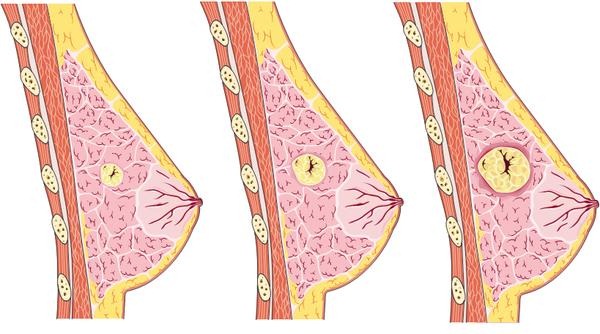Фиброзно-кистозная мастопатия: симптомы, лечение4