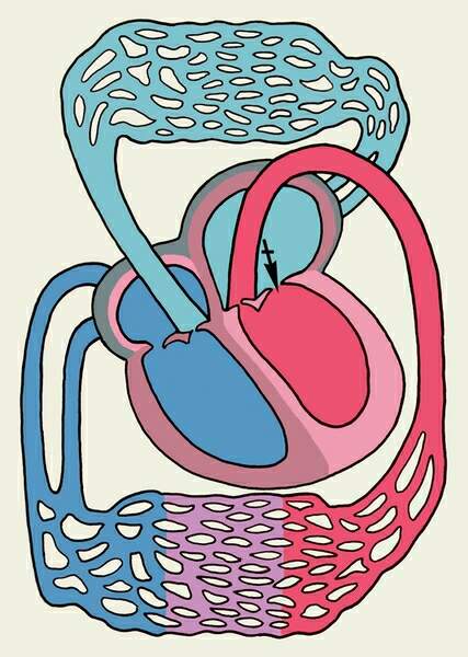 Общий артериальный ствол: описание, заболевания, лечение4