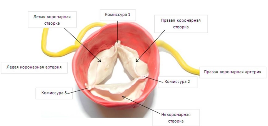 Стеноз аортального клапана: лечение, операция4