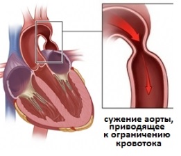 Коарктация аорты: симптомы, диагностика, лечение4