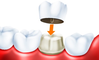 Почему болит зуб под коронкой 4