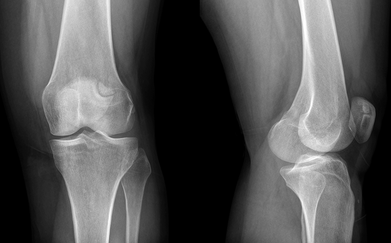 Артроз коленного сустава: лечение, симптомы, видео и фото, степени5