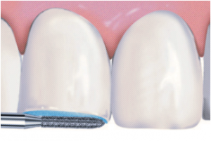 Препарирование зуба: показания, этапы, методы, последствия4