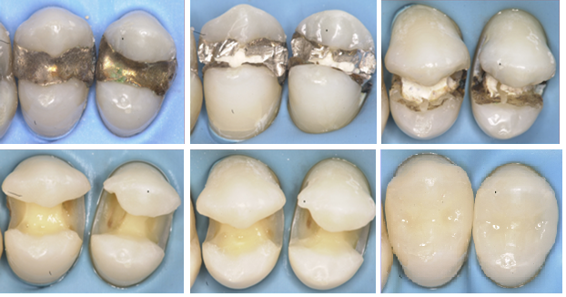 Материалы для восстановления зубов: виды, классификация, достоинства, недостатки4