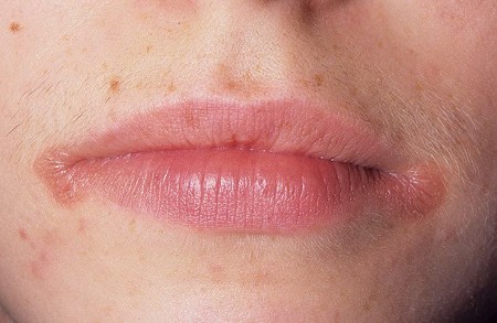 Трещины в уголках губ: причины, лечение, у ребенка, витамины4