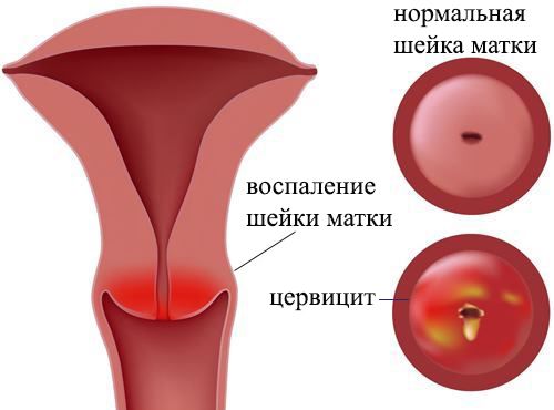 Хламидиоз у женщин: симптомы, лечение5
