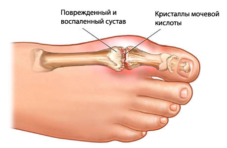 Лечение косточки на пальце ноги: боли, народные средства5