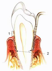Перелом корня зуба: лечение, методики терапии5