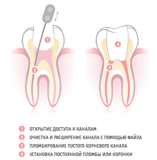 Реплантация зуба. Методики эндодонтического лечения зубов после травмы5