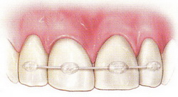 Шинирование зубов. Ременное шинирование: показания, этапы процедуры, последствия5